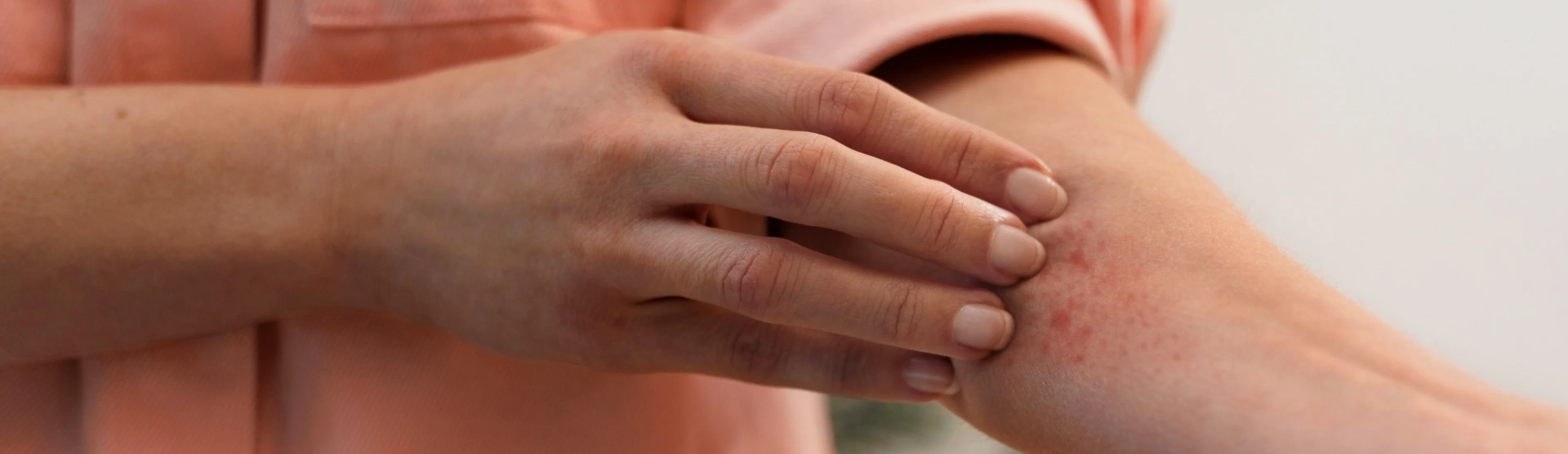 Essential Tips to Prevent Rashes in skins